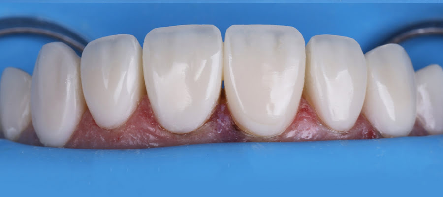 Close‑up of dental restoration surface after Lucida polishing demonstrating enamel‑like high gloss finish in clinical case study