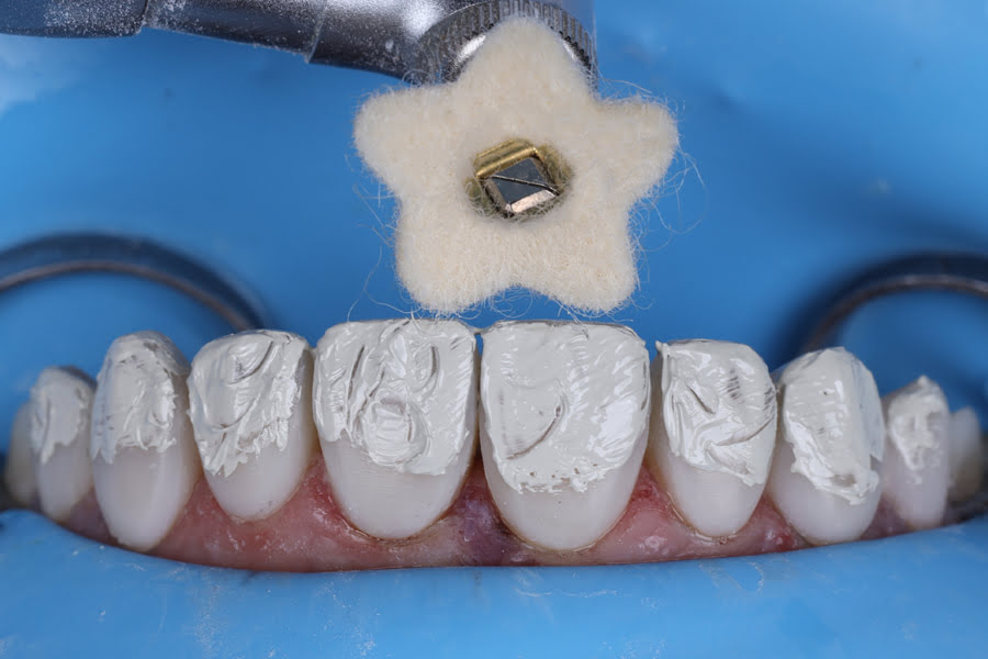 Clinical study showing composite layering and final Lucida polishing with DiaShine for high‑gloss anterior restoration finish