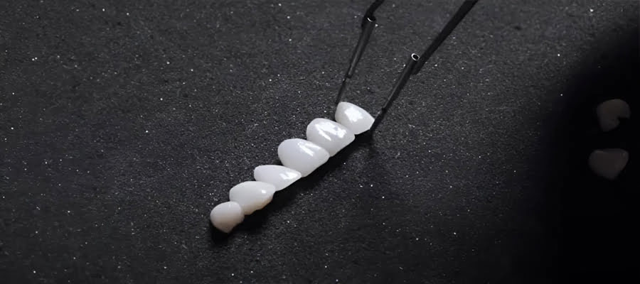 Before and after comparison of porcelain veneer finish showing natural gloss achieved with DiaShine Polish technique by Dr. Murray Orr