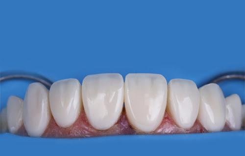 Dentist using DiaShine Lucida Composite Gloss System with Lucida Click felt star on handpiece to polish composite restoration to high gloss