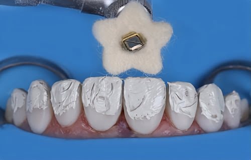 Close‑up of DiaShine Lucida polishing paste and Lucida Click felt stars demonstrating tools for achieving high‑gloss dental composite surface