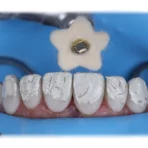 DiaShine Lucida polishing paste applied to polishing brush for achieving high gloss on dental restorations