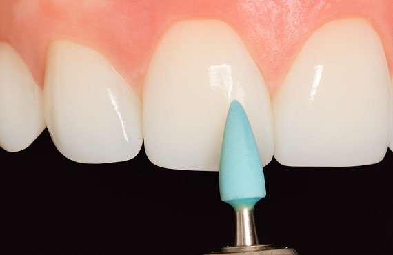 DiaTrim Green Diamond Bonded Ceramic Stone