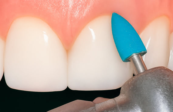 DiaFlex Blue Medium Diamond Rubber Pre Polisher