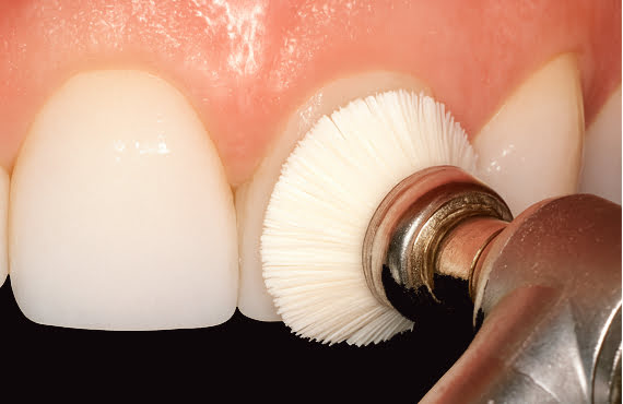 DiaShine Intra Oral Fine Diamond Polish with desired brush