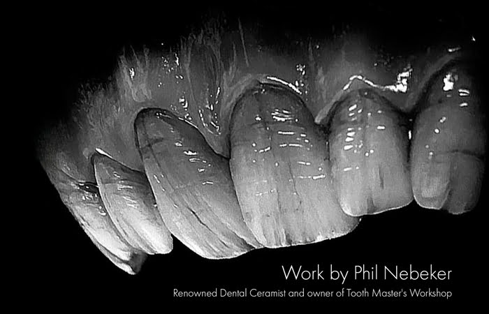 Dental ceramic restorations by Phil Nebeker