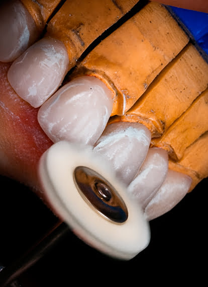 High-gloss finish on ceramic dental restorations