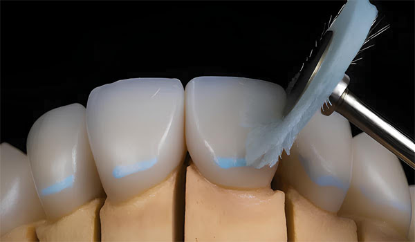 Teeth surface before dental polishing with DiaShine
